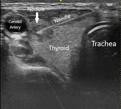 Ultrasounds fail to detect cancer. Head And Neck Fine Needle Aspiration Biopsy