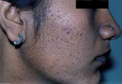 Indian Journal of Dermatology, Venereology & Leprology