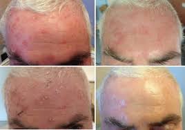 Normal cells stop dividing when they come into contact with like cells, a mechanism known as contact inhibition. Management Pearls On The Treatment Of Actinic Keratoses And Field Cancerization Springerlink