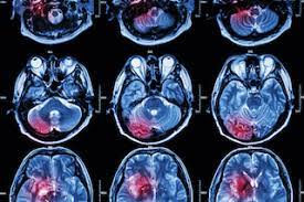 In the last 20 years, the american population as a whole has seen an increase of about 22 percent, and in people older than 65, that uptick in brain tumors is about 55 percent, according to statistics from the surveillance, epidemiology and end results (seer) program of the national cancer institute. Q A Advances In Brain Tumor Treatment Cancer Ut Southwestern Medical Center