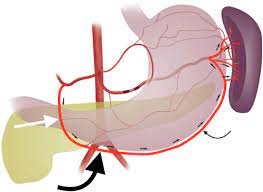 Embolotherapies have become mainstays of interventional radiology practice. Review Of Proximal Splenic Artery Embolization In Blunt Abdominal Trauma Cvir Endovascular Full Text