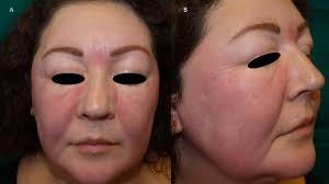Persistent Facial Oedema and Erythema in a Woman, An Uncommon Manifestation  of Chronic Cutaneous Lupus Erythematosus