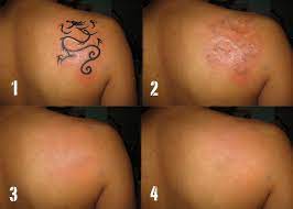 See reviews, photos, directions, phone numbers and more for the best tattoo removal in saint cloud, mn. Beloved Laser Covering Removing Tattoos Saint Paul Mn