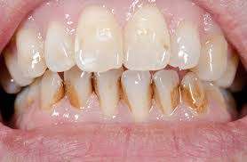 There are no risks or side effects, as long as. Teeth Whitening Treatment The Dental Studio Singapore