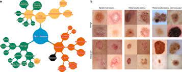 However, these relations are complex and differ according to skin cancer type. Dermatologist Level Classification Of Skin Cancer With Deep Neural Networks Nature