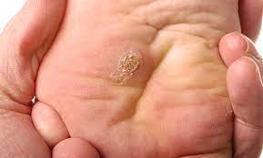 Die meisten warzen verschwinden nach einiger zeit von selbst. Dornwarzen Warzen Unter Dem Fuss Endwarts De