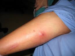 Bot flies (order diptera, family cuterebridae) are large, stout bodied, hairy flies that resemble bumblebees. Furuncular Myiasis From Dermatobia Hominus A Case Of Human Botfly Infestation Sciencedirect