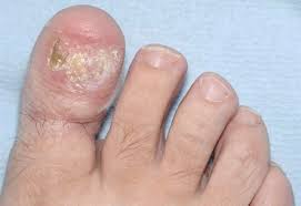 These look like bruises under the nails, and are usually along the bottom edge of the nail, near the cuticle. Marjolin S Squamous Cell Carcinoma Of The Hallux Following Recurrent Ingrown Toenail Infections Bmj Case Reports