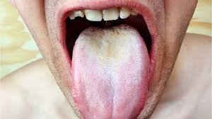 Image result for black hairy tongue symptoms