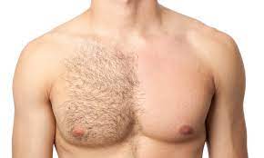 Ingrown hair on my chest. 42 Reasons You Deserve Laser Hair Removal Skinscience