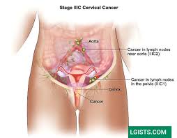 If you have any of these symptoms, visit your doctor, nurse, or cervical cancer screening is used to find abnormal cells in your cervix that could lead to cancer. Cervical Cancer Signs And Symptoms Lgists Com