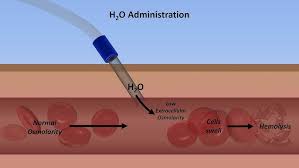 Image result for Hypernatremia