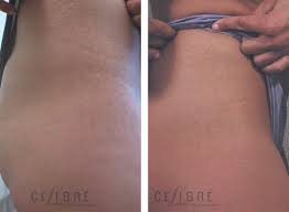 Bio Oil White Stretch Marks Before And After Stretch Marks Laser Removal Before After Pictures 4 Laser For Stretch Marks Laser Stretch Mark Removal Stretch Marks