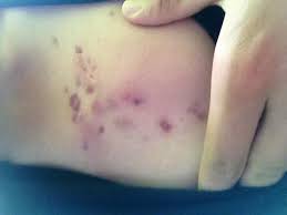 Akne Auf Der Brust Krankheit Pickel