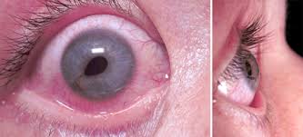 Traumatic Eye Injury Management Principles for the Prehospital Setting
