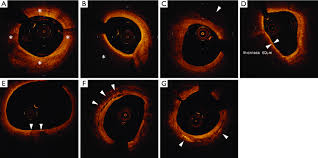 This step is important as it will help to soothe any irritation and move the broken down scar tissue for your lymphatic system to clean up. Images Of Plaque Phenotype On Oct A Fibrous Plaque Fibrous Plaque Download Scientific Diagram