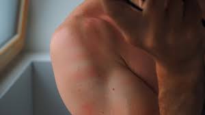 Signos y síntomas del cáncer de piel tipo skin cancer. Cancer De Piel Sintomas Factores De Riesgo Y Prevencion
