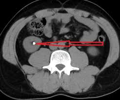 Image result for Nephrolithiasis Imaging