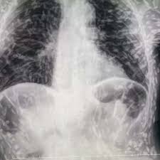 Após raio-X com tênia viralizar, entenda diferença entre cisticercose e  solitária