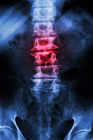 Is it verb or noun or adverb? Spondylosis Is Osteoarthritis Of The Spine