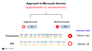 Image result for Microcytic Anemia
