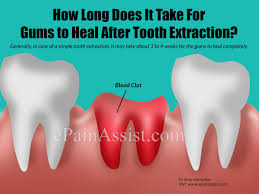 Are the recommendations after tooth extraction, with which you should familiarize directly specialist. How Long Does It Take For Gums To Heal After Tooth Extraction