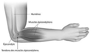 Définition, symptômes et facteurs de risque. La Tendinopathie Epicondylienne Epicondylite Et Le Travail