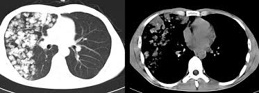 May have recurrent genetic translocations. Multiple Pulmonary Chondroid Hamartoma Journal Of Thoracic Oncology