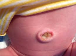 Since there is no longer a blood supply to nourish it, the umbilical cord stump will begin to dry up and wither away. Newborn Baby Umbilical Cord After It Falls Off Newborn Baby