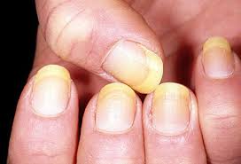 See more ideas about nails, nail designs, nail art designs. Nail Disorders What Nails Say About Your Health