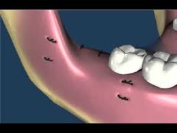 Dentistry Wisdom Teeth 1 Wisdom Teeth Removal Wisdom Teeth Wisdom Teeth Recovery