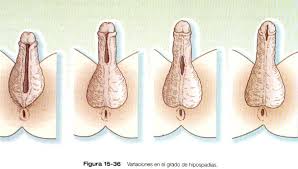 Hipospadias sadece ve sadece doğru zamanda, doğru kişiler tarafından cerrahi metod ile tedavi edilir. Hipospadias Centro Urologico