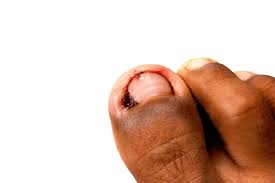 Image result for Paronychia feet