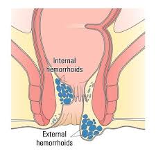 Image result for hemorrhoids