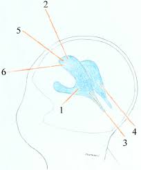 Schematic Illustration Of All The Extra Calvarial Ventricular Access Download Scientific Diagram
