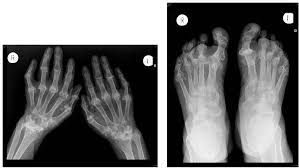 Rheumatoid arthritis is considered an indication for resurfacing of the patella during total knee arthroplasty. Extraskeletal Manifestations In Rheumatoid Arthritis Clinical Cases Intechopen