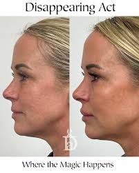 Finding a provider who can customize a treatment plan specifically for you  and then safely implement it is what we do at Disappearing Act 💜 This  gorgeous patient came in requesting a