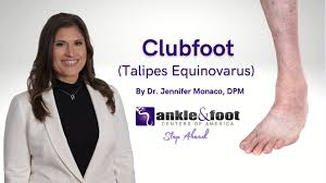 Image result for Clubfoot