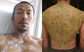 Kena Demam Campak Di Usia Dewasa Maskulin