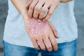 Image result for psoriasis