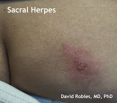 Rear view of man with wet clothes standing outdoors. David Robles Md Phd Dermatologist Sacral Herpes Genital Herpes Hsv 2 Presenting On The Buttock