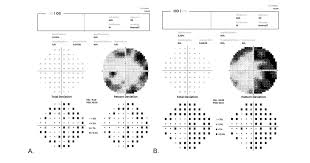 Image result for Acute Vision Loss