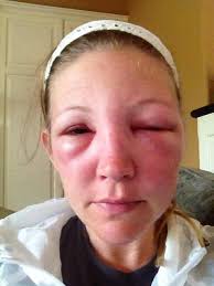 My Experience of a Bee Sting Near My Eye (With Photo Progression)