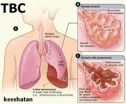 Kuman tuberkulosis dapat menyebar dengan cepat melalui batuk, bersin, berbicara, hingga meludah. 30 Macam Jenis Penyakit Cara Penularan Dan Pe Informasi Kesehatan