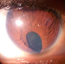 Image result for Coloboma