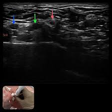 Image result for Superior Trunk Block