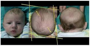 دور الخوذة الطبية بعد جراحة التحام عظام الجمجمة