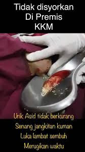 Badan sepatutnya membuang asid urik ini yang merupakan bahan kumuh daripada protein menerusi air kencing namun proses berkenaan boleh pesakit gout perlu mengekalkan berat badan mereka, ia merupakan aspek penting kerana jika gagal, jumlah asid urik dalam badan juga akan meningkat. Bedah Kaki Gout