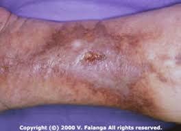 Image result for Lipodermatosclerosis