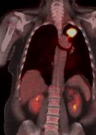 Image result for lung cancer xray